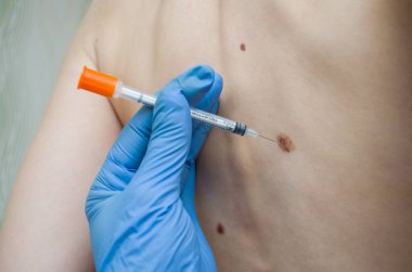 Doktor sırtındaki doğum lekesini inceliyor.