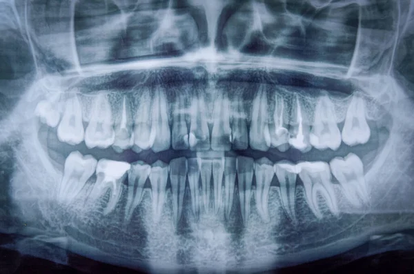 Panoramic x-ray scanning of human teeth. Women\'s the teeth with one tooth of wisdom