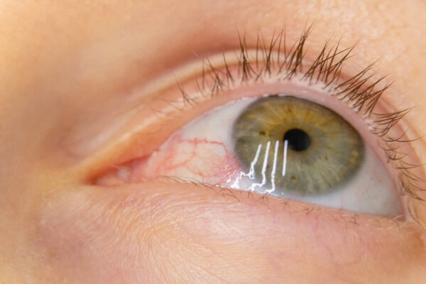Close-up of a woman's green eye with burst blood vessels, macrophotography