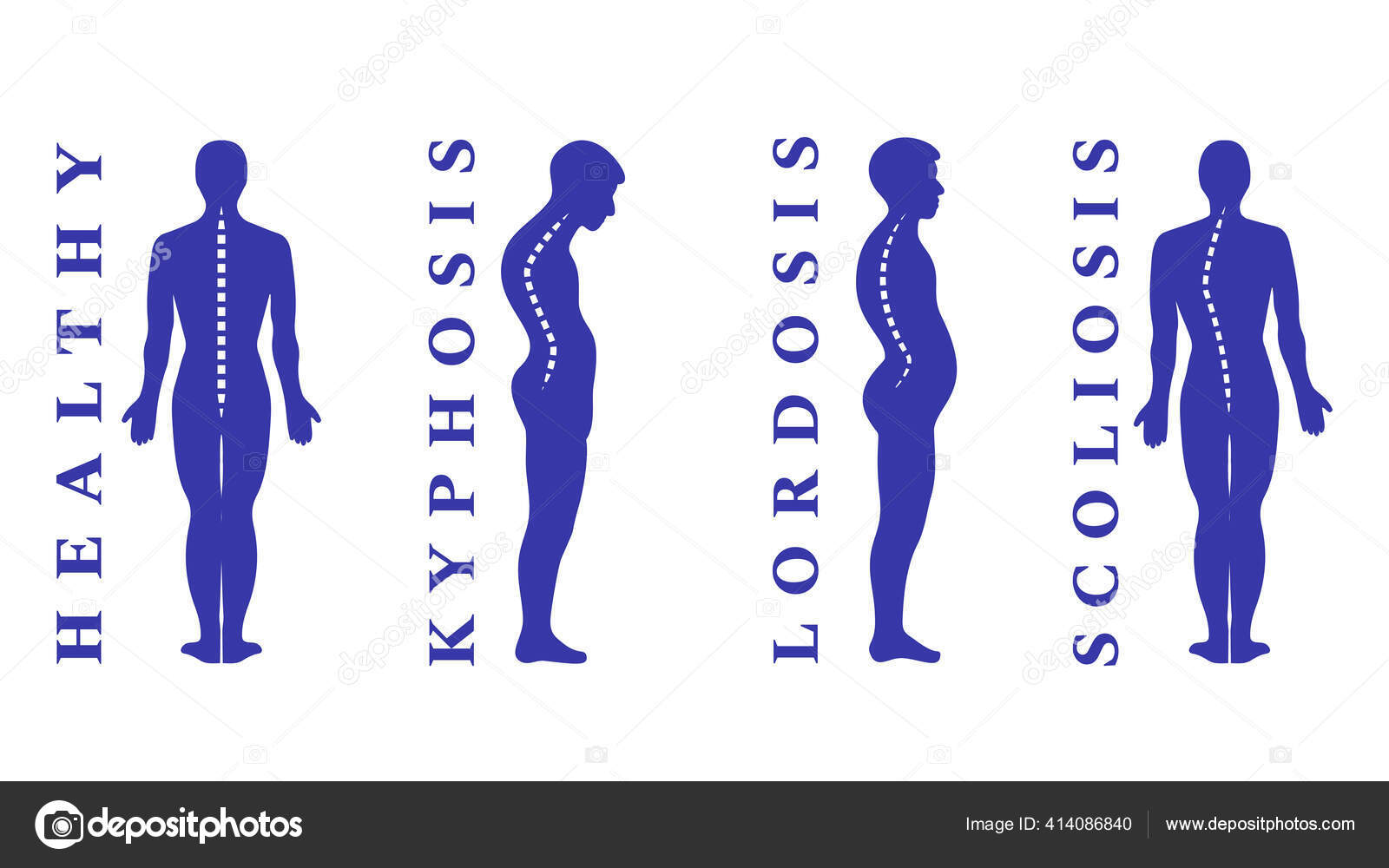 Diseases Spine Scoliosis Lordosis Kyphosis Body Posture Defects Back Diseases Spine Scoliosis Lordosis Kyphosis Body Posture Defects Back