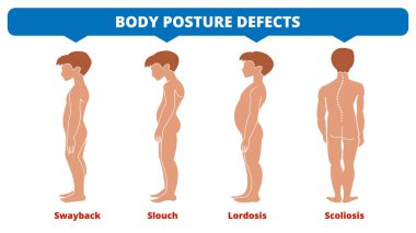 Omurga hastalıkları. Skolyoz, lordosis, salıncak, kambur. Vücut duruşu kusurlu. Omurga deformasyonu tipleri. Tıbbi hastalık bilgileri. Teşhis semptomu. Erkek silueti. Vektör illüstrasyonu