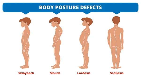 Gerincferdülés Scoliosis Lordosis Swayback Lomha Testtartás Hibák Gerincdeformitás Típusok Orvosi — Stock Vector