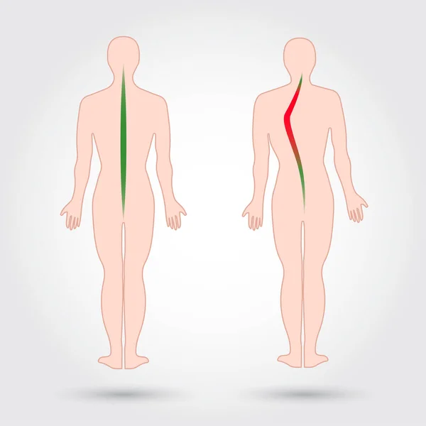 Sjukdom Ryggraden Skolios Fel Kroppshållningen Mänskliga Silhuetter Isolerade Vektorillustration — Stock vektor