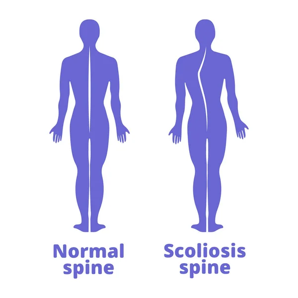 Gerincferdülés Scoliosis Testtartás Hiba Kék Emberi Sziluettek Elkülönítve Vektorillusztráció — Stock Vector