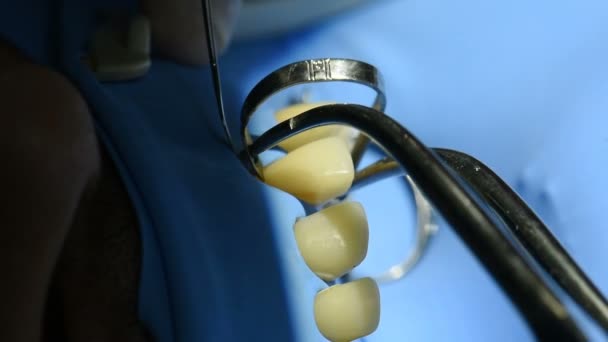 歯科医は 歯科医院で歯科用ツールで患者さんの歯を治療します 歯科の調節で歯のクローズ アップ ビュー — ストック動画