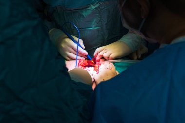 Cerrahlar hastanede çalışan takım. Yakın çekim yakışıklı, ameliyat sırasında hekimlerin.