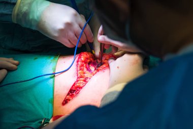 Cerrahlar hastanede çalışan takım. Yakın çekim yakışıklı, ameliyat sırasında hekimlerin.