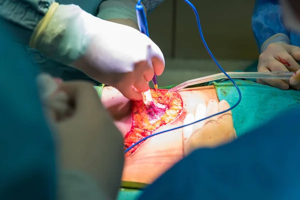 Cerrahlar Hastanede Çalışan Takım Yakın Çekim Yakışıklı Ameliyat Sırasında Hekimlerin — Stok fotoğraf