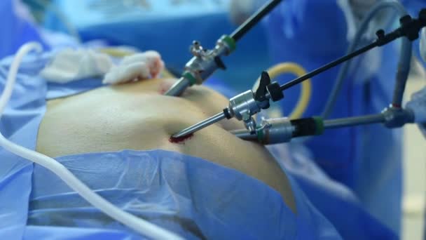 Gros Plan Sur Les Mains Chirurgien Pratiquant Une Chirurgie Laparoscopique — Video