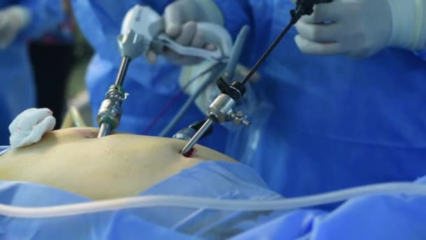 Close Van Chirurg Handen Uitvoeren Laparoscopische Chirurgie — Stockvideo