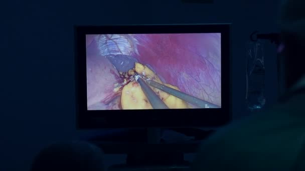 Chirurg Die Laparoscopische Chirurgie Uitvoert Laparoscopische Chirurgie Monitor Chirurgen Voeren — Stockvideo