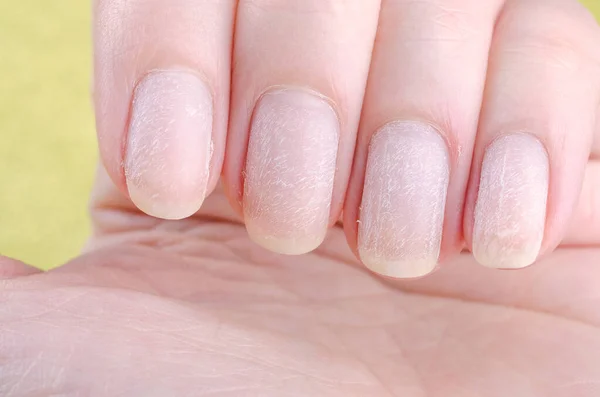 Поврежденные ногти после удаления современного геля лак для ногтей — стоковое фото