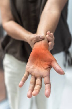 Elindeki, avuç içi, parmakları ve duyusal sinirleri uyuşmuş, ağrıyan, kas zayıflığı olan, bıçaklayan, kronik iltihaplı demiyelinasyon sonucu yanan yaşlı hastada nöropati ağrısı.