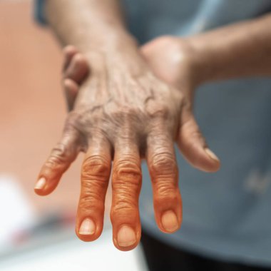 Elindeki, avuç içi, parmakları ve duyusal sinirleri uyuşmuş, ağrıyan, kas zayıflığı olan, bıçaklayan, kronik iltihaplı demiyelinasyon sonucu yanan yaşlı hastada nöropati ağrısı.