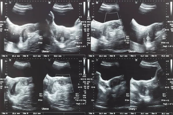 Ultraschallbild Von Unterbauch Eierstock Und Gebärmutter Mit Tumor Oder Gebärmuttermyom — Stockfoto