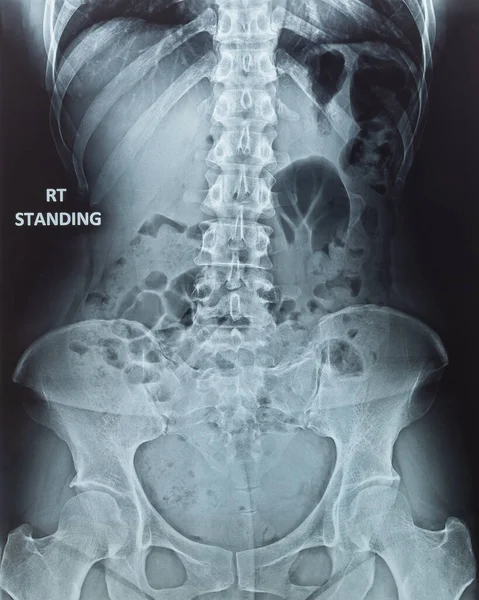 Röntgen Der Menschlichen Rückenwirbelsäule Röntgen Mit Digitaler Bildgebung Film Zeigt — Stockfoto