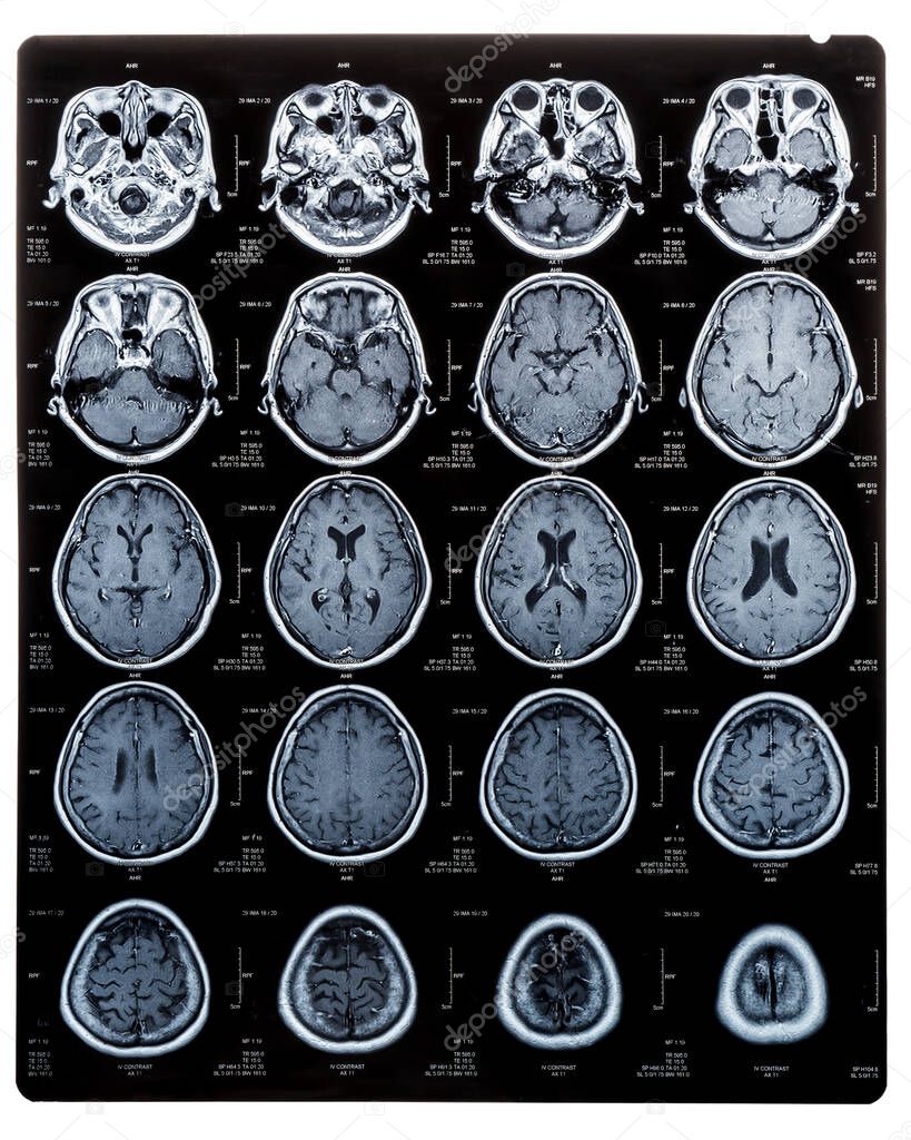 Brain scan image on Magnetic Resonance Imaging (MRI) film of elderly patient isolated (clipping path) for neurological medical diagnosis on brain disease