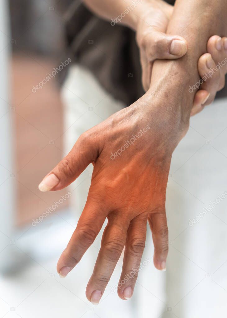 Peripheral Neuropathy pain in elderly patient on hand, palm, fingers and sensory nerves with numb, aching, muscle weakness, stabbing, burning from chronic inflammatory demyelinating polyneuropathy