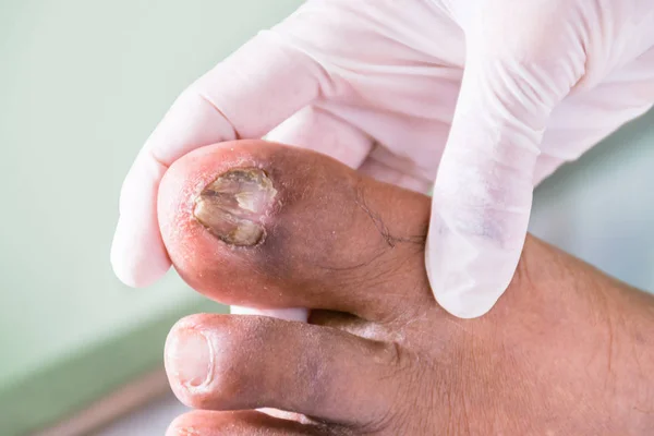 Fungus Foot Nail Break Bad Smell Bed Patient — Stock Photo, Image