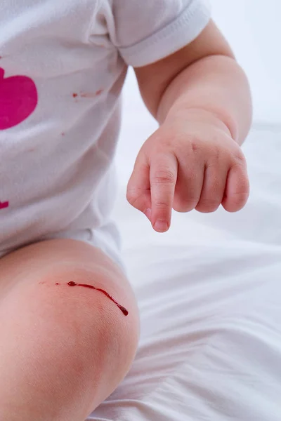 Toddler girl pointing on bleeding scratch on her knee.