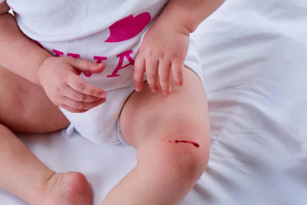 Niña apuntando a un rasguño sangrante en su rodilla . — Foto de Stock