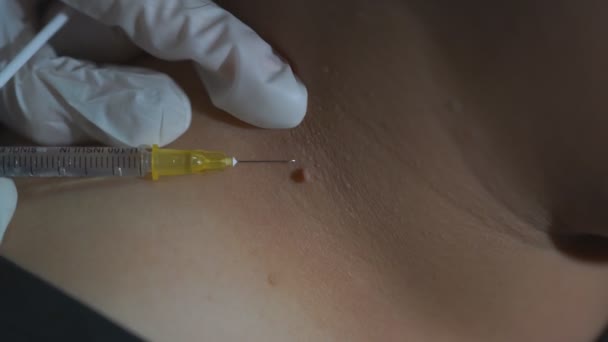 Close Video Chirurg Injecteren Lokale Verdoving Rond Mol Voor Chirurgische — Stockvideo