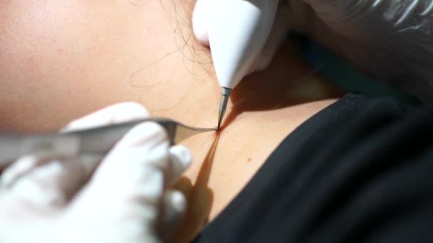 Arzt Entfernt Maulwurf Chirurgischem Eingriff Durch Ausschneiden Mit Medizinischen Werkzeugen — Stockvideo