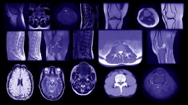 Οι μαγνητικές τομογραφίες θέτουν πολυοθόνη, ανθρώπινο εγκέφαλο, κεφάλι, σώμα, οστά, σπονδυλική στήλη και όργανα. Κινούμενα stop motion ψηφιδωτό διαφόρων μερών του σώματος αξονική τομογραφία ή x ray. Ανατομία παλμών χωρίς ραφή. — Αρχείο Βίντεο