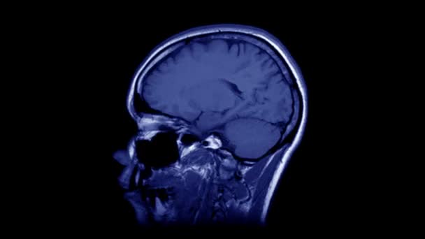 Tidsfördröjning av MRT-hjärnskanning, timelapse av blå magnetisk resonanstomografi av ett mänskligt huvud. Stoppa rörelse vy av datortomografi med anatomiska detaljer. Sömlös loop animation av det mänskliga huvudet. — Stockvideo