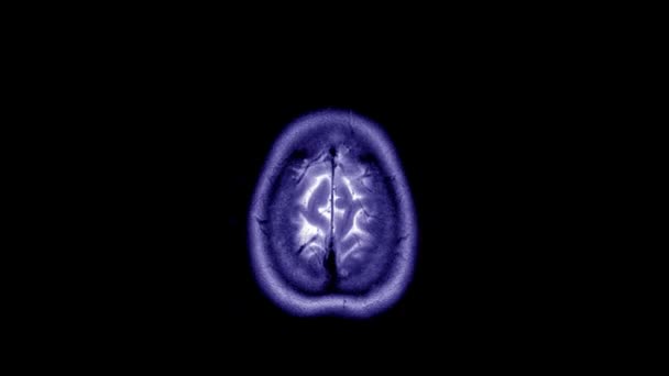 Time lapse of MRI brain scan, timelapse of blue magnetic resonance imaging of a human head. Vue d'arrêt de CT scan avec des détails anatomiques. Animation en boucle sans couture de la tête humaine. — Video