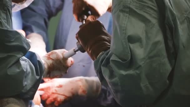 Operace Kyčelního Kloubu Rukou Chirurga — Stock video