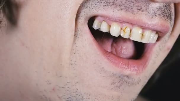 Tooth Guy Takes Out Fallen Tooth His Mouth — Stock Video