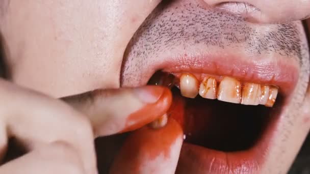 Zahn Mann Zieht Sich Einen Gefallenen Zahn Aus Dem Mund — Stockvideo