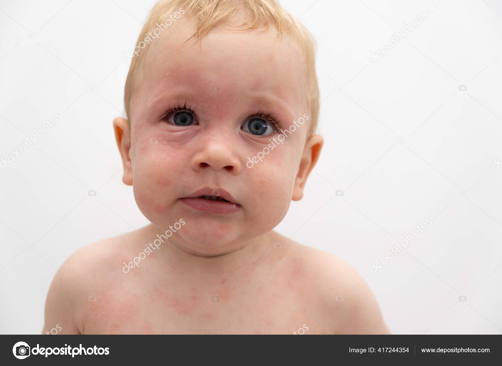 Close Portrait Toddler Swollen Eye Severe Allergic Reaction Stock
