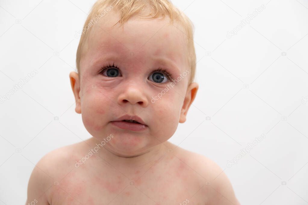 Close up portrait of toddler with swollen eye. severe allergic reaction