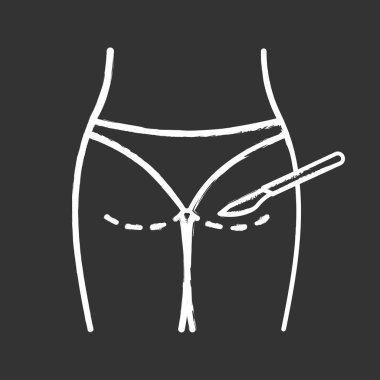 Gluteoplasty tebeşir simgesi. Kalça büyütme ve liposuction. Kalça kaldırma ameliyatı. Plastik cerrahi. İzole vektör kara tahta çizim
