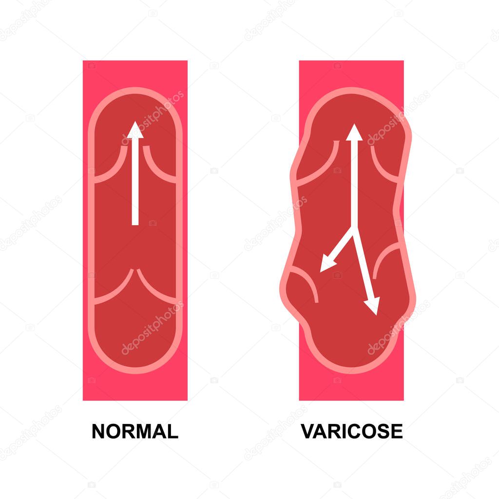 Vector varicose vein and normal vein on white. Stock vector icon