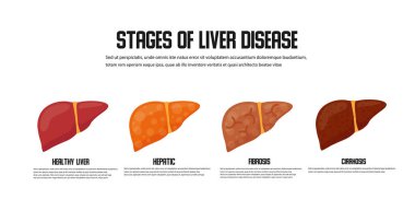 Stages of liver damage concept. Vector icon clipart