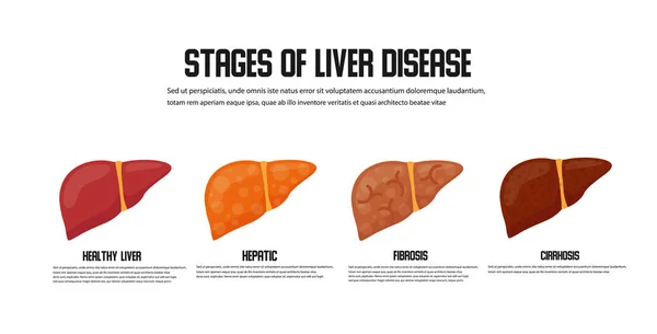 肝臓障害概念の段階 ベクトルのアイコン — ストックベクタ