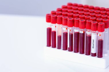 Covid-19, araştırma laboratuarındaki bir masada bulunan tüpteki kan örneğini enfekte etti.