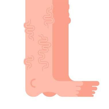 Varisli bacakları izole. Damar Hastaligi ayak. Vektör illustratio