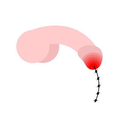 Penis hasta. Cinsel yolla bulaşan hastalıklar. bel soğukluğu ve frengi. Genital enfeksiyonu