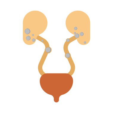 Böbreklerde taşlar. Nephrolithiasis böbrek taşları hastalığı. Medica