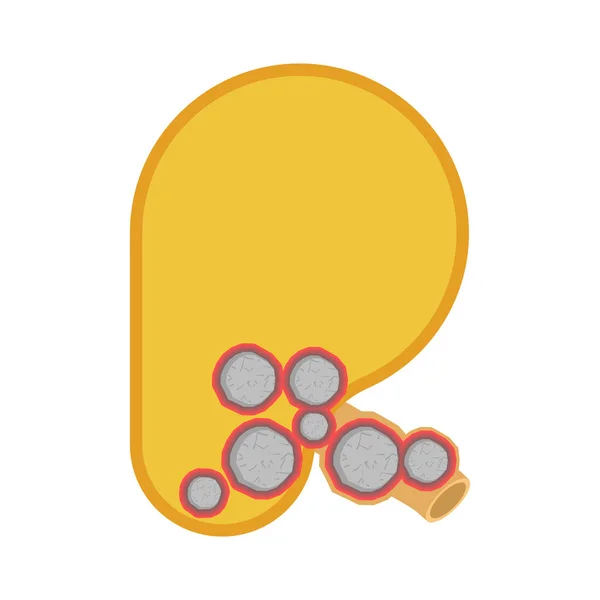 Piedras en los riñones. Enfermedad de cálculos renales nefrolitiasis. Medica — Archivo Imágenes Vectoriales