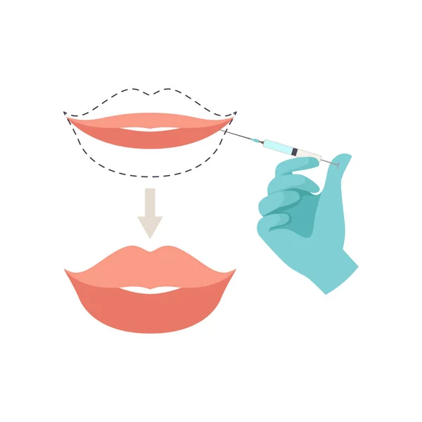 Procedimiento de aumento de labios, vector de inyecciones de labios de ácido hialurónico Ilustración sobre fondo blanco — Vector de stock