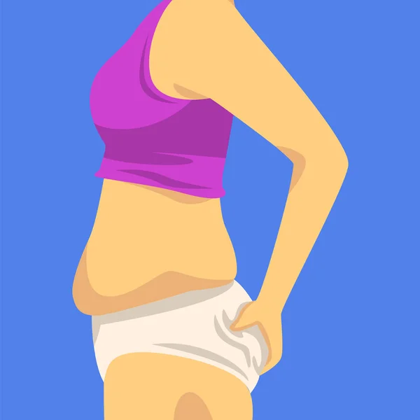 Parte del cuerpo femenino con vientre graso, figura humana después de la pérdida de peso, vista lateral, obesidad y problemas de alimentación poco saludables Vector ilustración — Archivo Imágenes Vectoriales