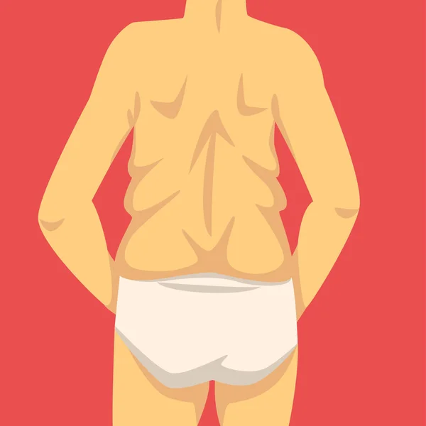 Torso masculino, cuerpo humano después de la pérdida de peso, vista posterior, obesidad y problemas de alimentación poco saludables Vector Illustration — Archivo Imágenes Vectoriales