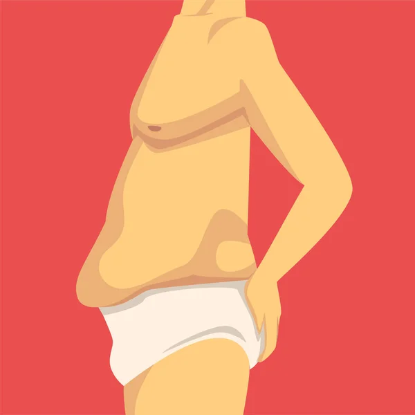 Männlicher Oberkörper mit schlaffem Fettbauch, menschlicher Körper nach Gewichtsverlust, Seitenansicht, Fettleibigkeit und ungesunden Essstörungen Vektorillustration — Stockvektor