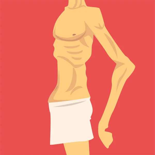 Torso maschile con basso peso e pancia cadente, corpo umano dopo la perdita di peso, vista laterale, obesità e problemi alimentari malsani Illustrazione vettoriale — Vettoriale Stock