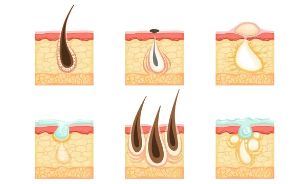 Conjunto de imágenes de la piel con raíces de pelo, acné y sudor. Ilustración vectorial . — Vector de stock